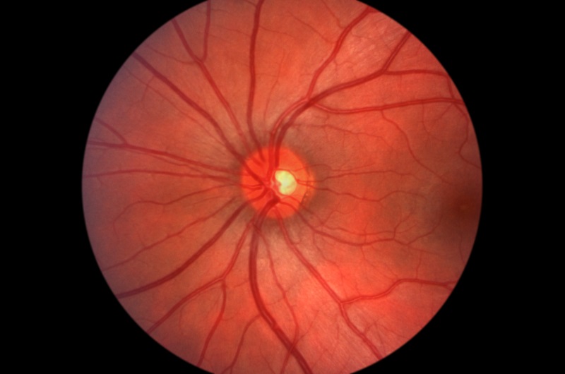 Glaucoma  Tulare, CA, 